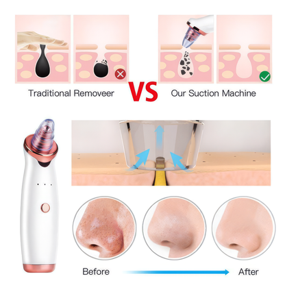 Blackhead Remover